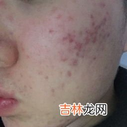 如何淡化痘印方法,如何淡化痘印生活小妙招