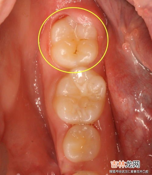 龋齿和蛀牙有什么区别,蛀牙是什么
