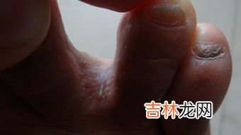 脚气为什么会起水泡,为什么脚上起水泡