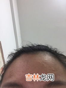 为什么额头会长痘,额头老长痘是什么原因？