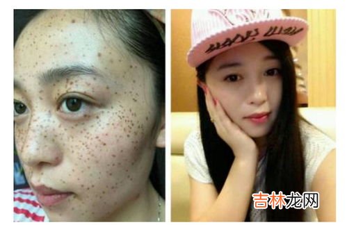女人脸上为什么会长斑,女人脸上长斑是什么原因