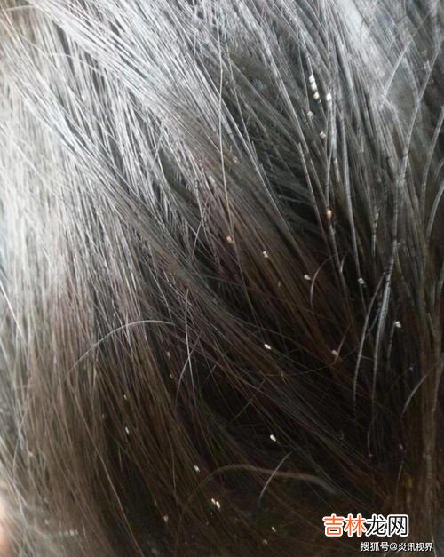 虱子是从哪里长出来的,虱子是怎么长出来的