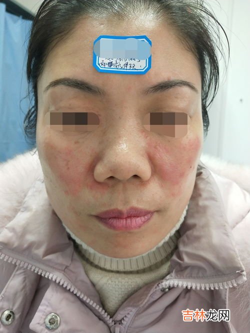 脸上刺痛是什么原因,脸上感觉刺痛怎么回事