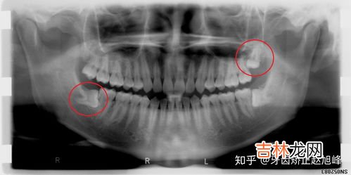 每个人都会长智齿吗,人的智齿什么时候才会长?是每个人都会长么?