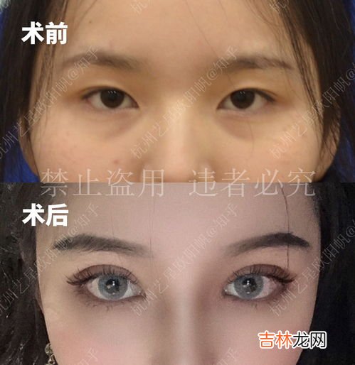 外双和内双的区别,双眼皮有内双和外双之分吗