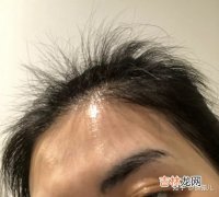 掉头发很厉害怎么办 掉发如何解决,头发掉的太严重怎么解决