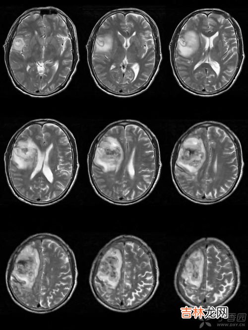 脑梗死的病人可以吃沙蒜胶囊吗,完美沙蒜软胶囊效果怎么样