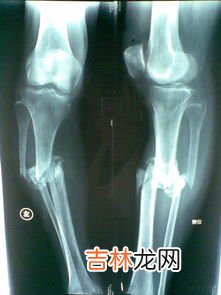 腓骨怎么读,腓骨的读音腓骨的读音是什么