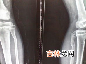 腓骨怎么读,腓骨的读音腓骨的读音是什么