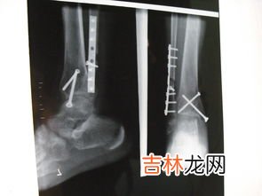 腓骨怎么读,腓骨的读音腓骨的读音是什么