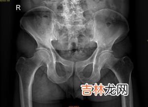 腓骨怎么读,腓骨的读音腓骨的读音是什么