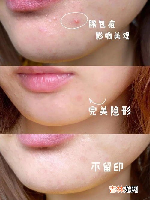 为什么下巴老起大脓痘,下巴长脓包型痘痘什么原因?