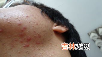为什么下巴老起大脓痘,下巴长脓包型痘痘什么原因?