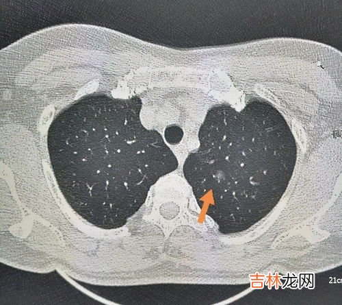 西想八甘能治肺结节吗,西想八甘大连什么地方卖