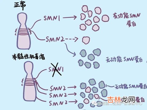 sma是什么疾病,SMA是什么病的英文简称