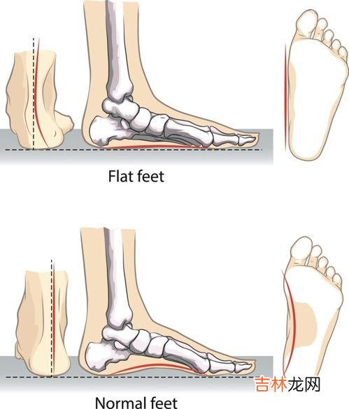 扁足平是什么,什么是扁平足