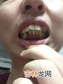 拔牙为什么会脸肿,拔牙后为什么会脸肿和喉咙痛