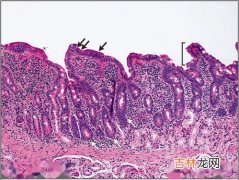 胃窦糜烂为什么要活检,胃窦粗糙,四周见多发凹陷糜烂,伴有鲜血斑点,活检四枚是什么意思?