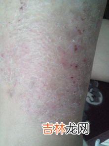 为什么会有皮肤病,狗狗为什么会皮肤病