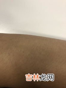 为什么手上会长瘊子,我是做足疗工作的最近手指长出一个瘊子一样的东西是怎么回事