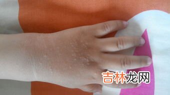 为什么手上会长瘊子,我是做足疗工作的最近手指长出一个瘊子一样的东西是怎么回事
