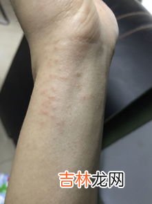 为什么手上会长瘊子,我是做足疗工作的最近手指长出一个瘊子一样的东西是怎么回事
