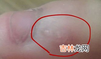 为什么手上会长瘊子,我是做足疗工作的最近手指长出一个瘊子一样的东西是怎么回事