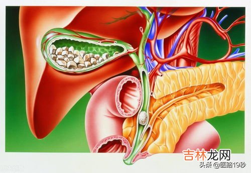 胆结石为什么要切除胆囊,胆结石一定要切除胆囊吗？胆结石究竟有多严重呢？