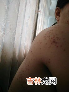 为什么怀孕会长痘痘,怀孕为什么会长痘痘?