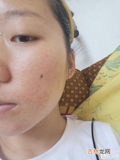 为什么怀孕会长痘痘,怀孕为什么会长痘痘?