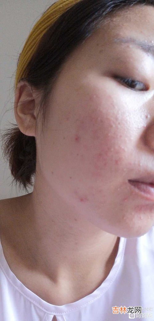 为什么怀孕会长痘痘,怀孕为什么会长痘痘?