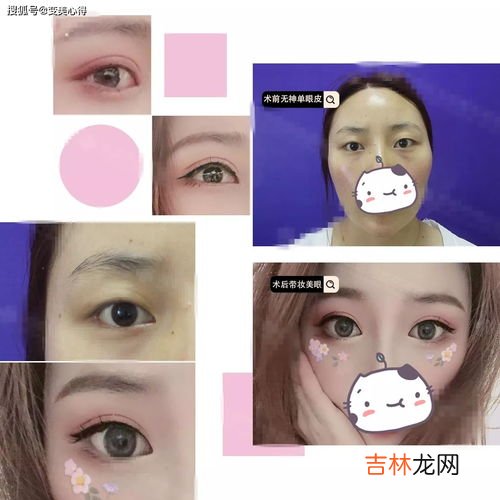 为什么双眼皮变成了三眼皮,双眼皮变三眼皮是什么原因