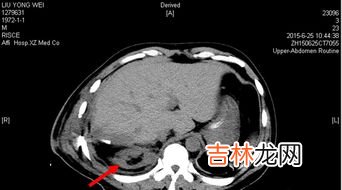 肾为什么会萎缩,肾变小了，是什么原因？