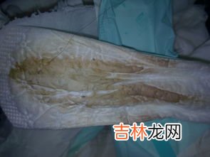 为什么白带是褐色,白带里有褐色分泌物是什么原因