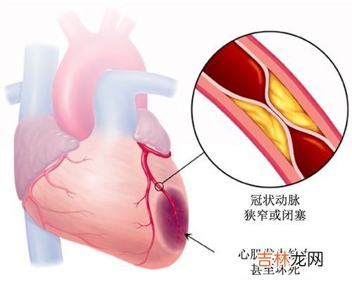 为什么会心肌梗塞,冬春寒冷季节和清晨多发心肌梗死，为什么？