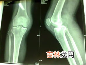 风湿三项是哪三项,风湿五项和风湿三项有什么区别