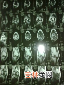 风湿三项是哪三项,风湿五项和风湿三项有什么区别