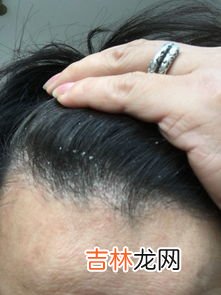 为什么有头皮屑特别多,头皮屑多是什么原因?
