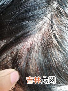 为什么有头皮屑特别多,头皮屑多是什么原因?