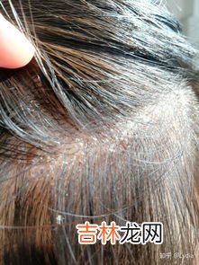 为什么有头皮屑特别多,头皮屑多是什么原因?