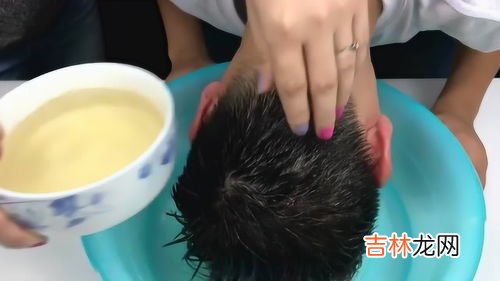 为什么有头皮屑特别多,头皮屑多是什么原因?