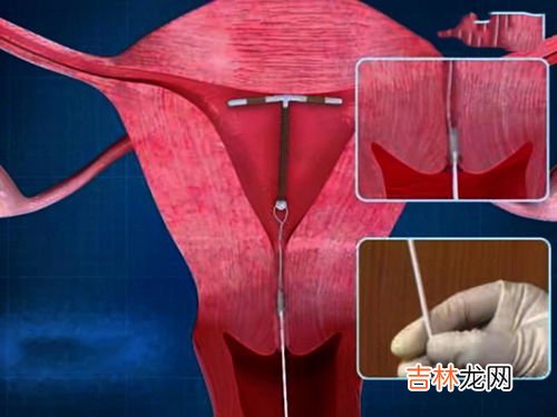 节育环为什么会下移,节育环下移