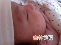 被蚊子咬了为什么会起包,被蚊子叮咬后，为什么会起红包呢？