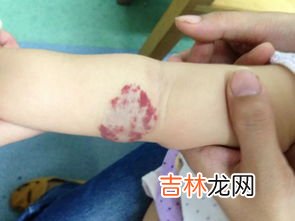 宝宝为什么会长血管瘤,婴儿血管瘤是什么