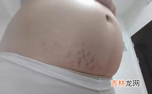 为什么腿上会有妊娠纹,为什么大腿上有妊娠纹