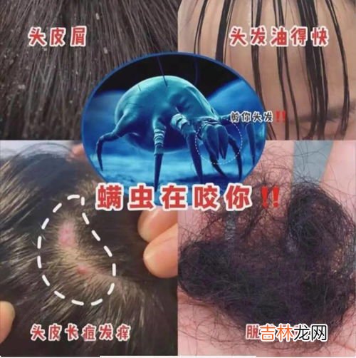 头皮上白泥如何清洁,从头皮上抠下来的“白泥”是什么？该如何解决？