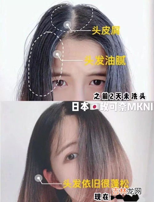 头皮上白泥如何清洁,从头皮上抠下来的“白泥”是什么？该如何解决？