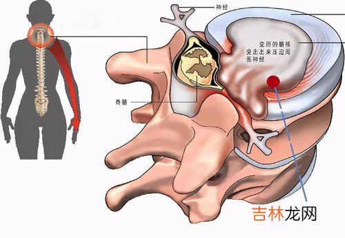 高血压手麻为什么,身体较胖,血压高,但身体很热为什么手有麻木呢？