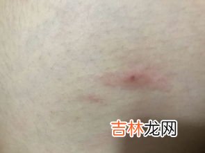 蚊子咬了为什么会起包,被蚊子叮咬后，为什么会起红包呢？