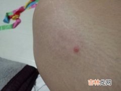 蚊子咬了为什么会起包,被蚊子叮咬后，为什么会起红包呢？